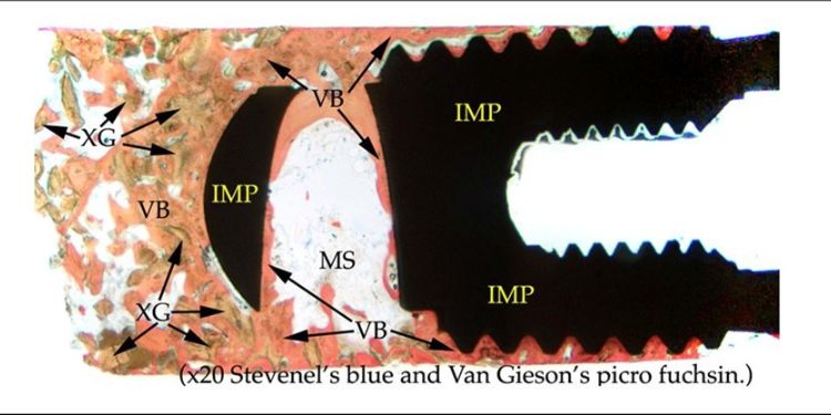 Article: Histologic and Histomorphometric Evaluation of Implant Osseointegration of a Dental Implant Three Years in Function Removed Due to Abutment Fracture